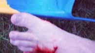 A SURFER has escaped with minor cuts and stitches after fighting off a shark clamped on to his foot at Lighthouse Beach on Wednesday evening. After detailed forensic analysis of the victim’s wounds and flipper damage, shark biologists from the Department of Primary Industries have determined […]