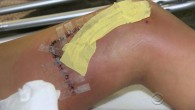 Shark attacks are on the rise along the California coast. “Beach access to the water is closed today because we had a girl get bit by a shark,” said one park official. Beachgoers were greeted by scary warning after 35-year-old […]